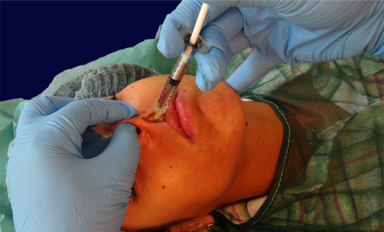 endopeel rhinoplasty step8