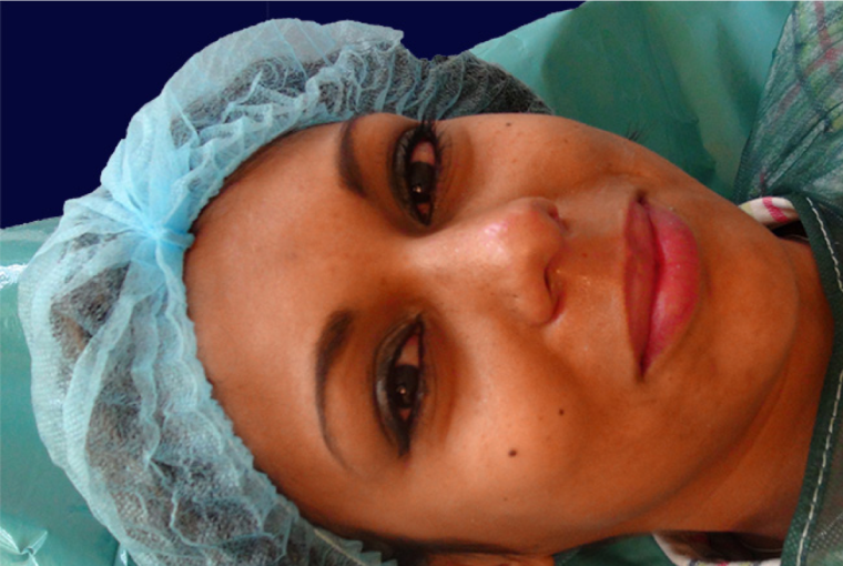 endopeel rhinoplasty step10