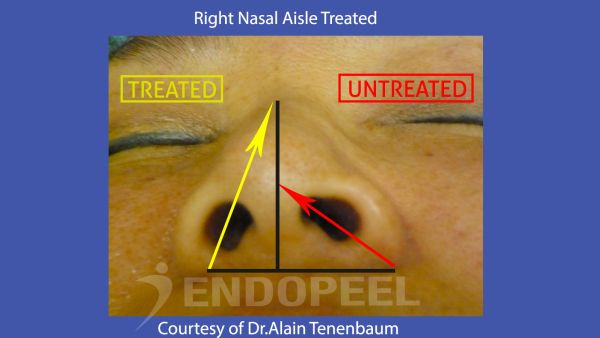 Nasal Aisle on Japanese Female with Endopeel