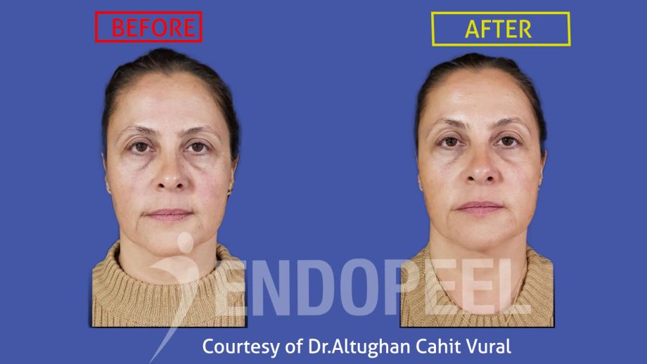 rhinoplastyDr.Altughan-Cahit-Vural-endopeel