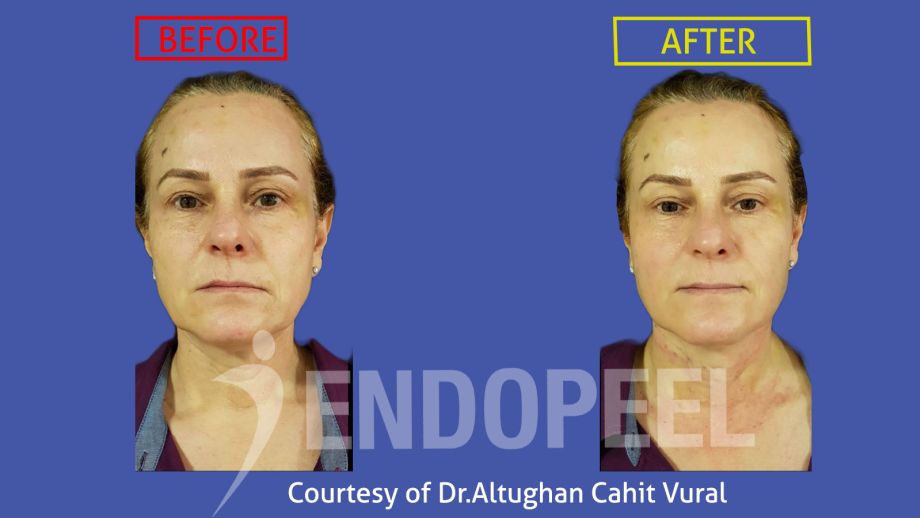 rhinoplasty Dr.Altughan-Cahit-Vural Endopeel