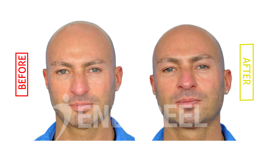 Rhinoplasty Dr Alain Tenenbaum