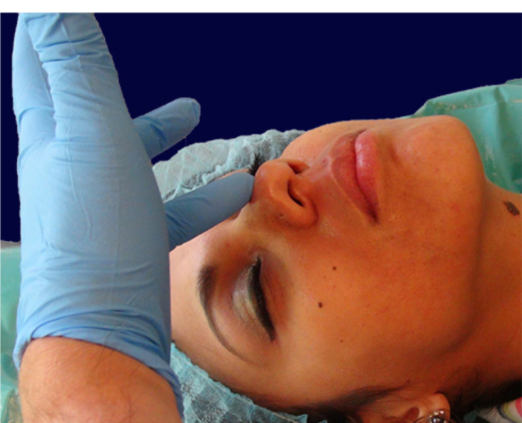 endopeel rhinoplasty step3