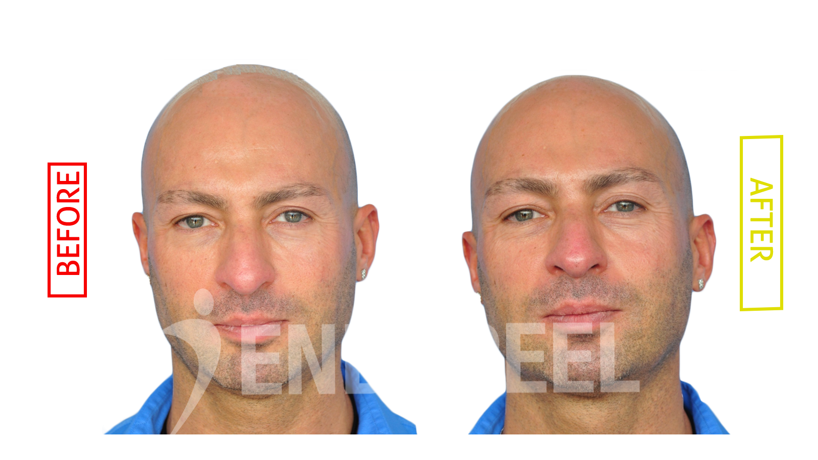 rhinoplasty endopeel co inventor Mauro Tiziani